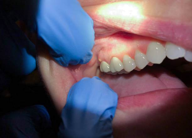 Urgent Tooth Repair in FL